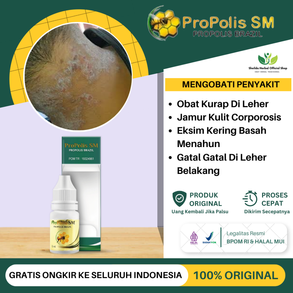 Jual Obat Kurap Di Leher Penghilang Jamur Kulit Corpolis Dermatofitosis Kurap Kering Gatal