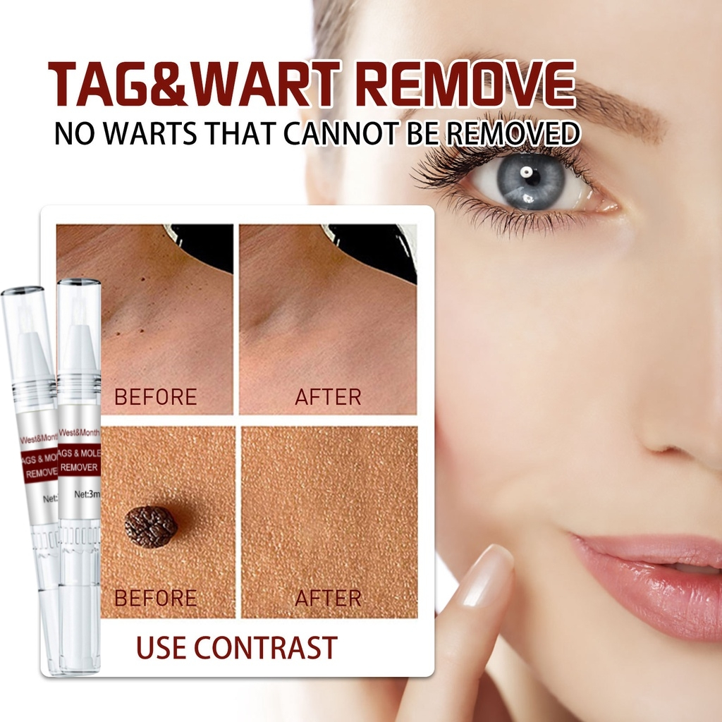 Penghilang Kutil Dan Tahi Lalat Di Wajah Skin Tag Remover Leher - foto 1
