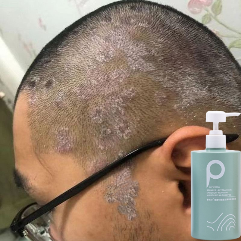 Jual Sampo Anti Ketombe Shampoo Psoriasis Penghilang Ketombe Berkerak Dan Gatal Anti Jamur 5884