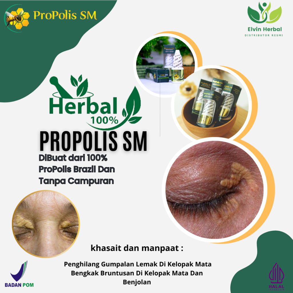 Jual Elvin Herbal Obat Xanthelasma Penghilang Gumpalan Lemak Di