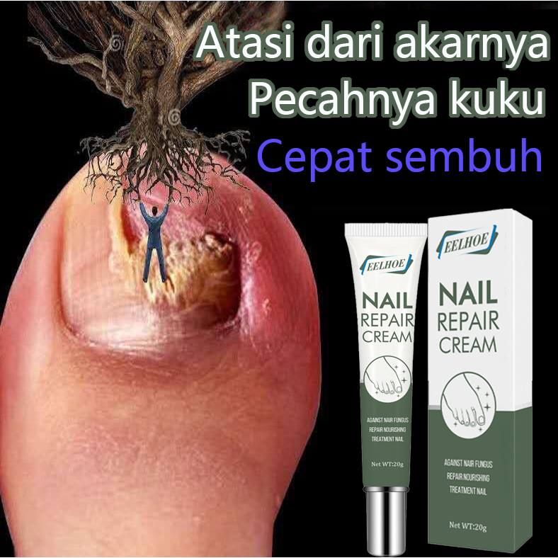 Jual G Obat Kuku Jamur Dan Rusak Perawatan Esensi Serum Paronychia