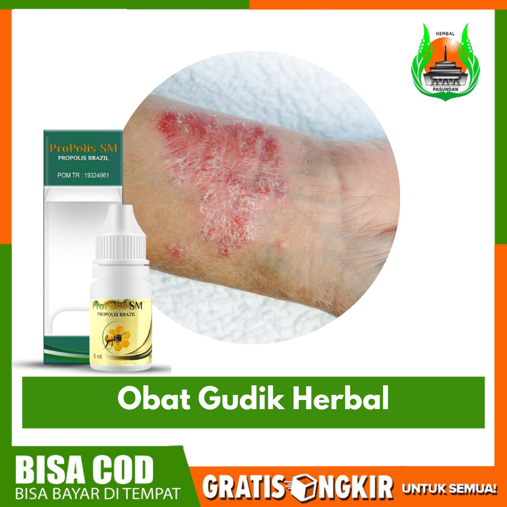 Jual Obat Gudik Herbal , Kudis , Panuan , Eksim, Scabies Herbal ...
