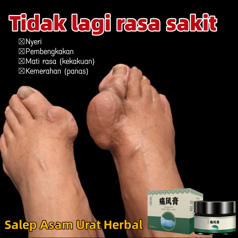 Jual （Asli）Obat asam urat Obat nyeri sendi Salep herbal asam urat 35g ...