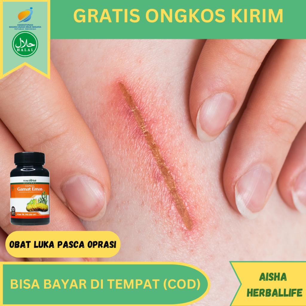 Jual Kapsul Herbal Mempercepat Pengeringan Luka Pasca Oprasi Luka Robek