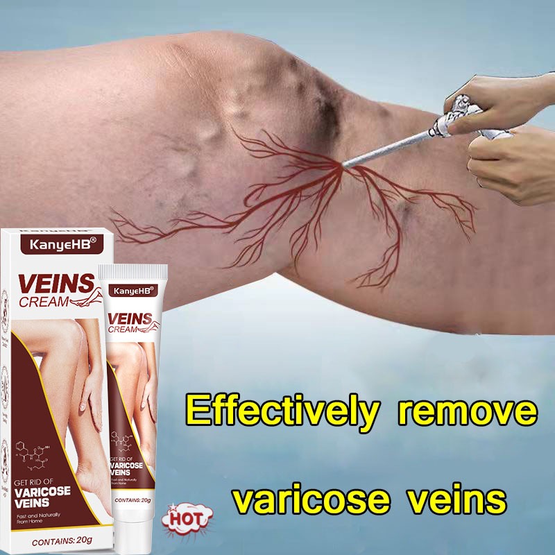 Jual Kanyehb Maikang Cream Varicose Veins Obat Varises Di Kaki Dan