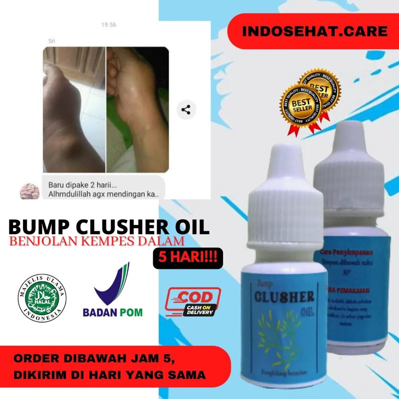 Jual Hari Benjolan Kempes Obat Oles Benjolan Bump Clusher Penghilang Benjolan Di Tangan