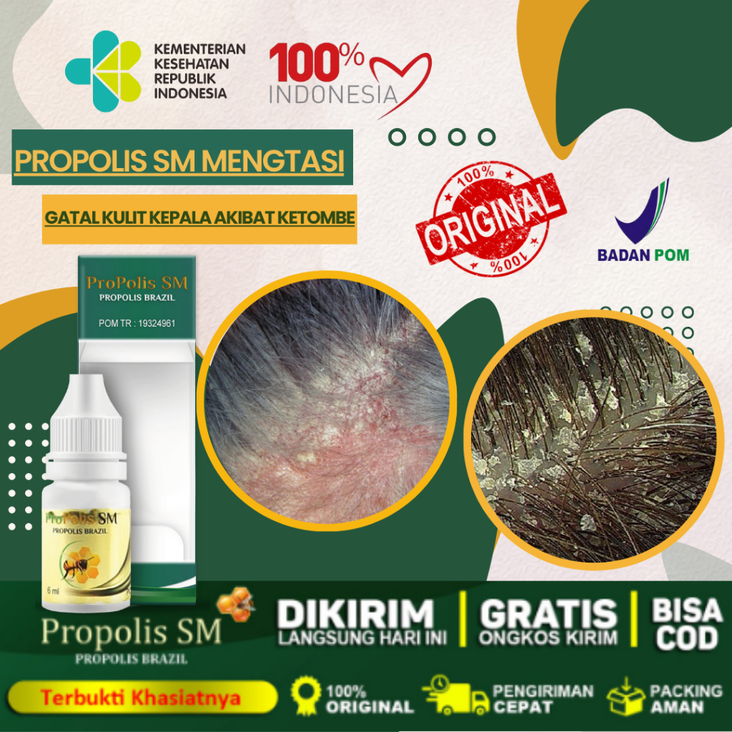 Jual Obat Penghilang Gatal Di Kulit Kepala Akibat Infeksi Jamur Psoriasis Ketombe Parah 4756