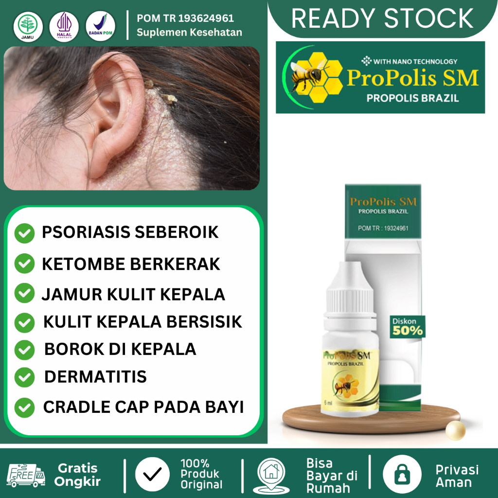 Jual Obat Tetes Ketombe Berkerak Kulit Kepala Bersisik Jamur Kulit