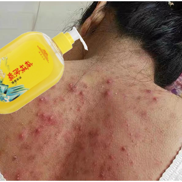 Jual sabun jerawat punggung sabun sulfur untuk gatal acne body wash