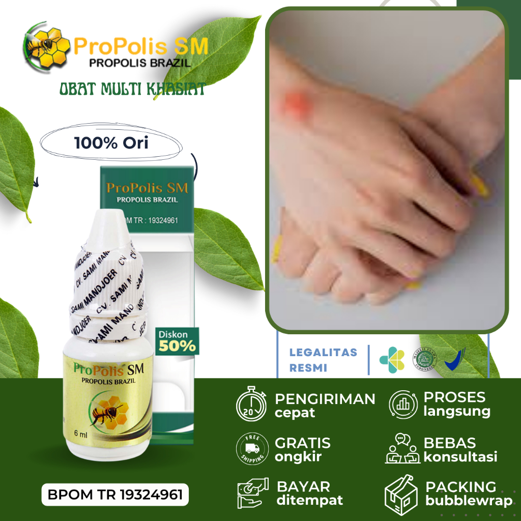 Jual Obat Benjolan Di Tangan,kista Ganglion,benjolan Lipoma Propolis SM ...