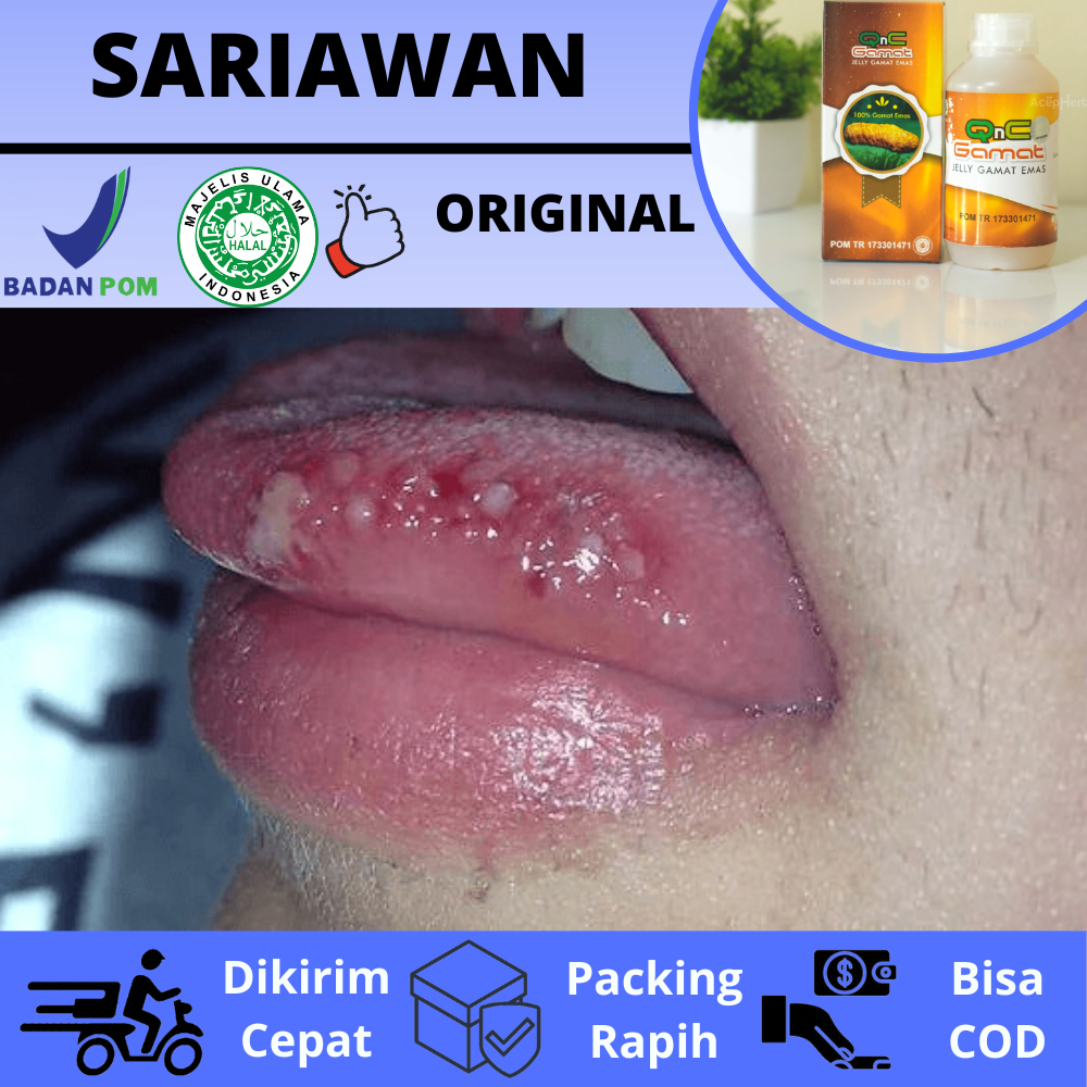 Jual Obat Oles Sariawan Kronis Sembuhkan Luka Lecet Perih Di Bibir Lidah Langi Langit Mulut