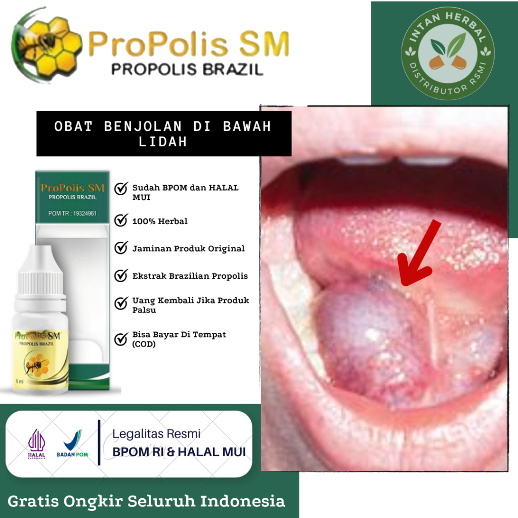 Jual Propolis SM - Obat Benjolan di Bawah Lidah, Benjolan di Langit