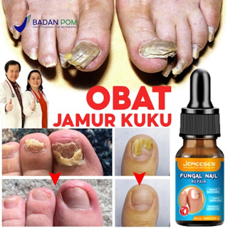 Jual Jemeesen Obat Jamur Kuku Dan Rusak Perawatan Kuku Berjamur