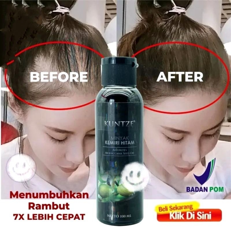 Jual Penumbuh Rambut Botak Penyubur Rambut Rontok Penghitam Rambut ...