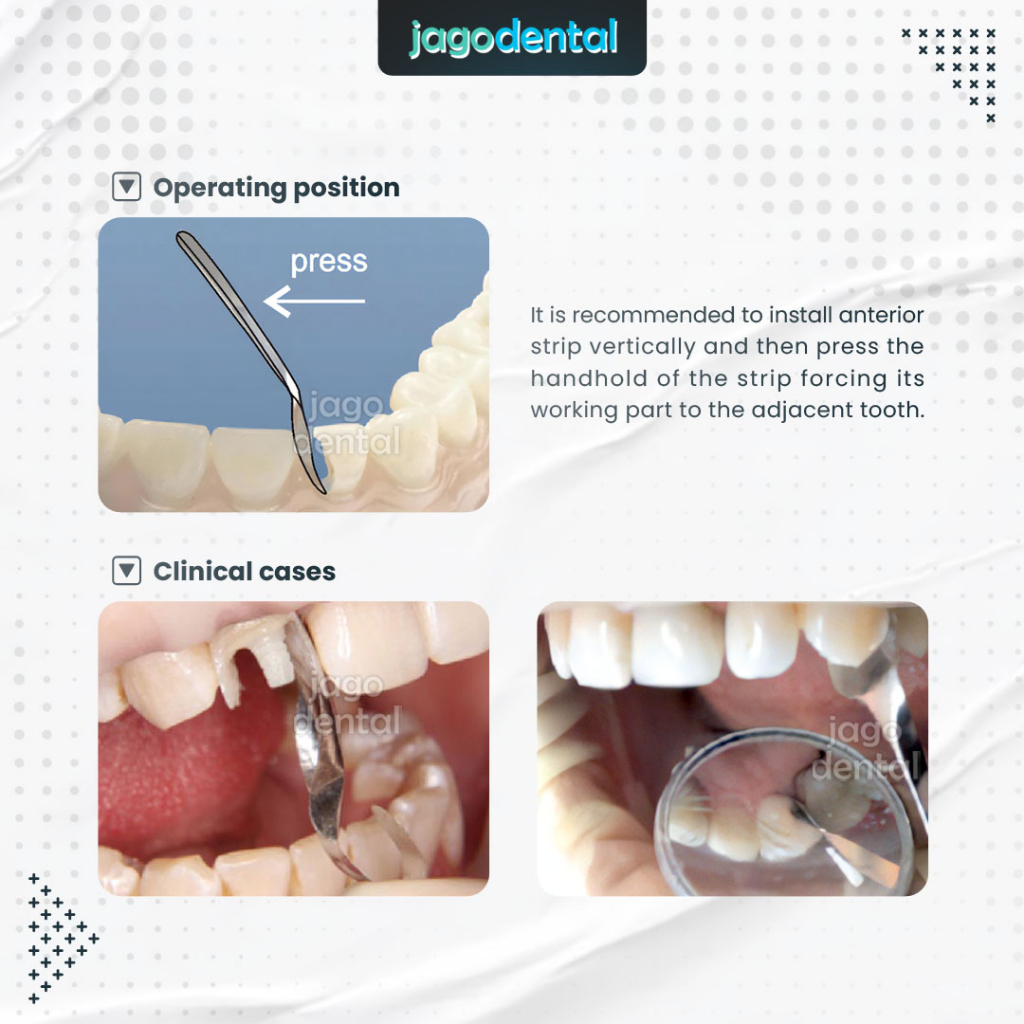 Jual DENTAL TWIN MATRIX ANTERIOR / RESTORASI SENDOK GIGI DEPAN TOR ...