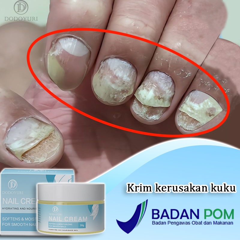 Jual 【BPOM】Serum Kuku Jamur Dan Rusak Obat Kuku Jamur Dan Rusak Obat ...