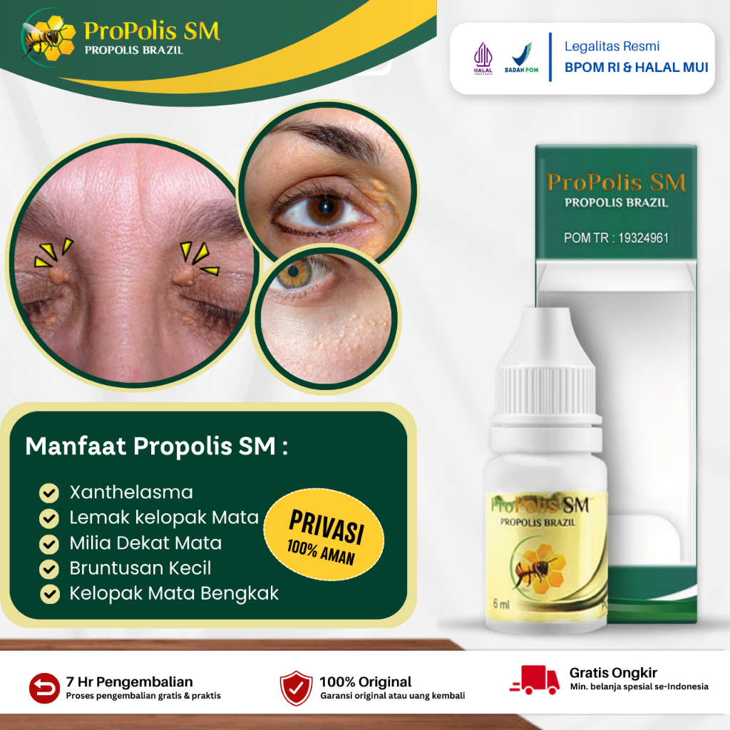 Jual Obat Xanthelasma Penghilang Gumpalan Lemak Di Kelopak Mata Bengkak ...