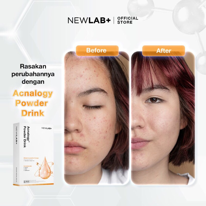 Jual NEWLAB Acnalogy Powder Drink | Minuman untuk Jerawat | Suplemen ...