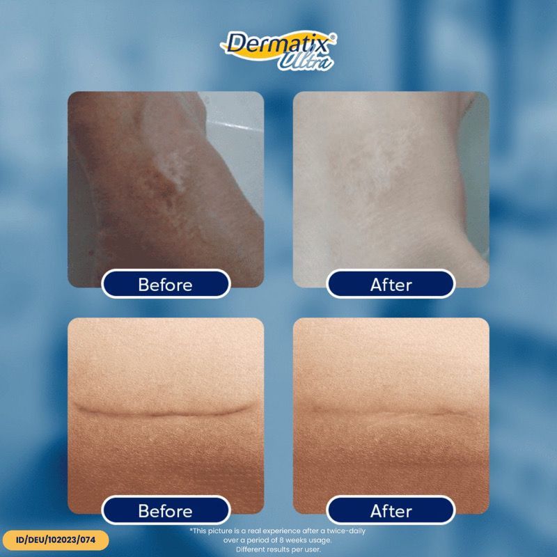 Dermatix Ultra 15gr Cream Penghilang Bekas Luka, Jerawat - foto 3
