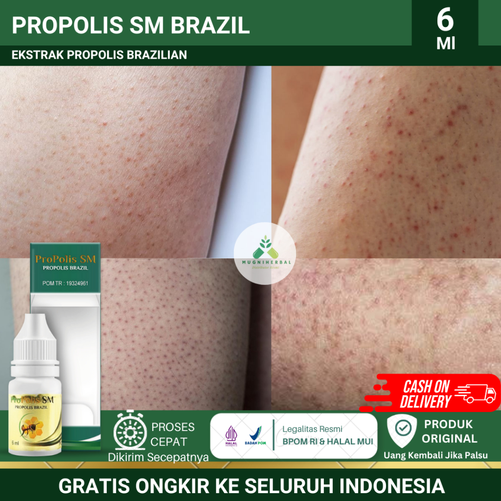 Jual Propolis Sm Obat Keratosis Pelaris Penyakit Kulit Ayam Salep