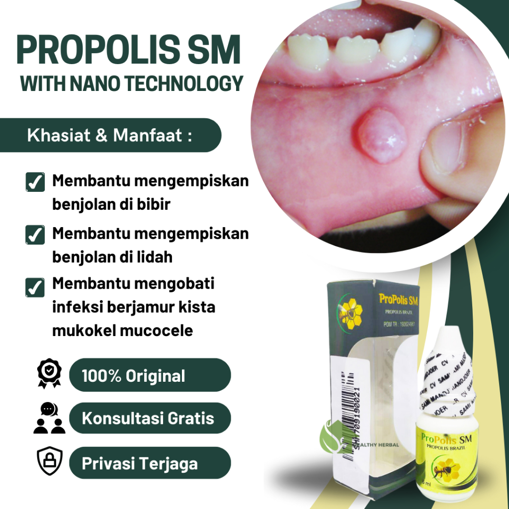 Jual Obat Benjolan Di Lidah Mucocele Tetes Bercak Putih Di Lidah Mulut