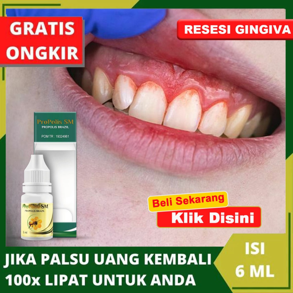 Jual Obat Gusi Turun Merosot Resesi Gingiva Periodontitis Radang Gusi ...