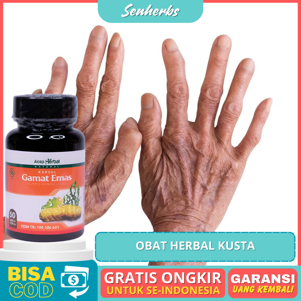 Jual Obat Untuk Penyakit Kusta Alami Kusta Kering Basah Lepra Infeksi ...