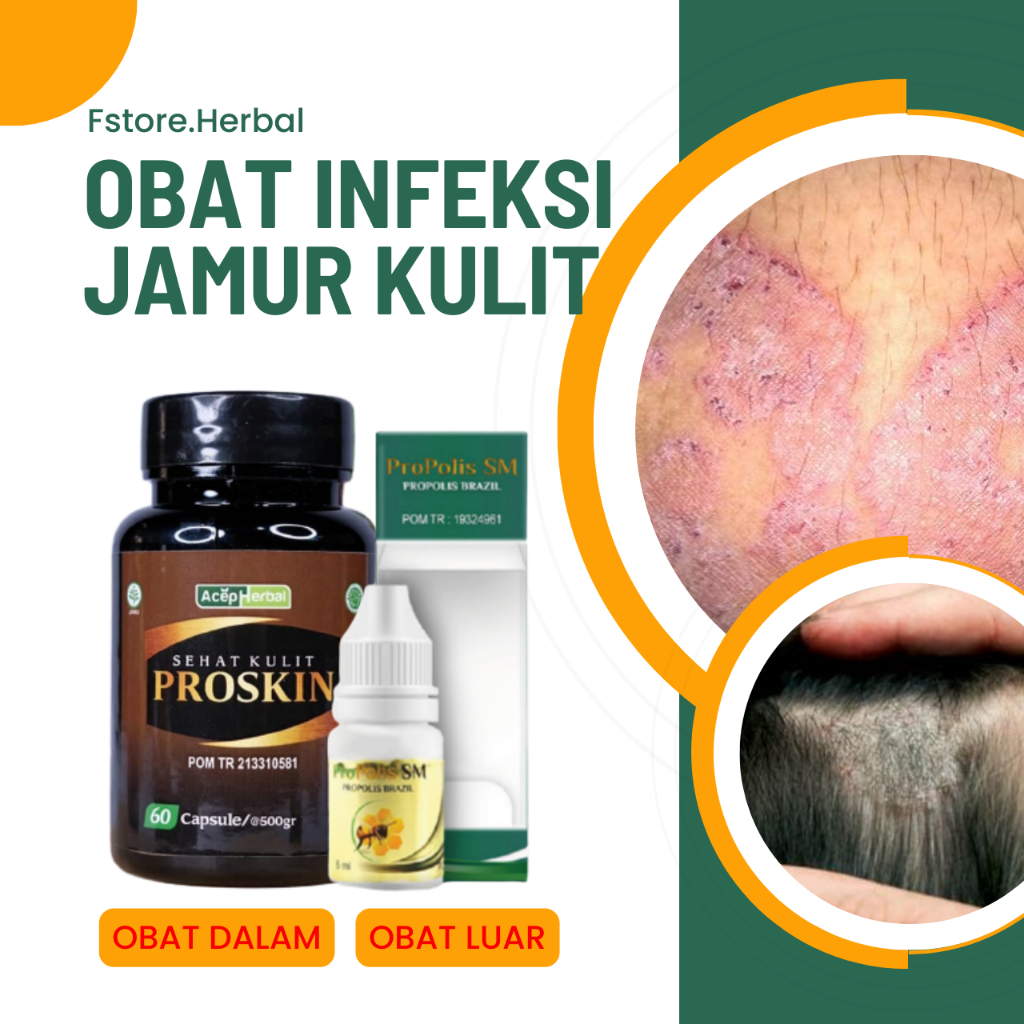 Jual Obat Scabies Gatal Kulit Seluruh Badan Selangkangan Jamur Kulit ...