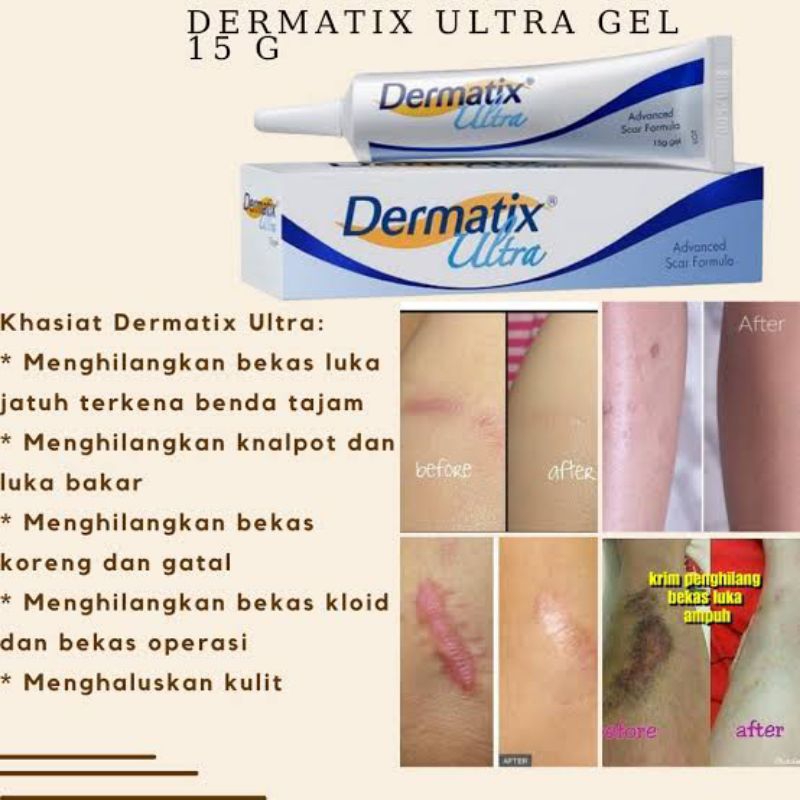 Jual Dermatix Ultra Gelgel Untuk Menghilangkan Bekas Luka Dan Anti Keloid 15 G Shopee Indonesia 