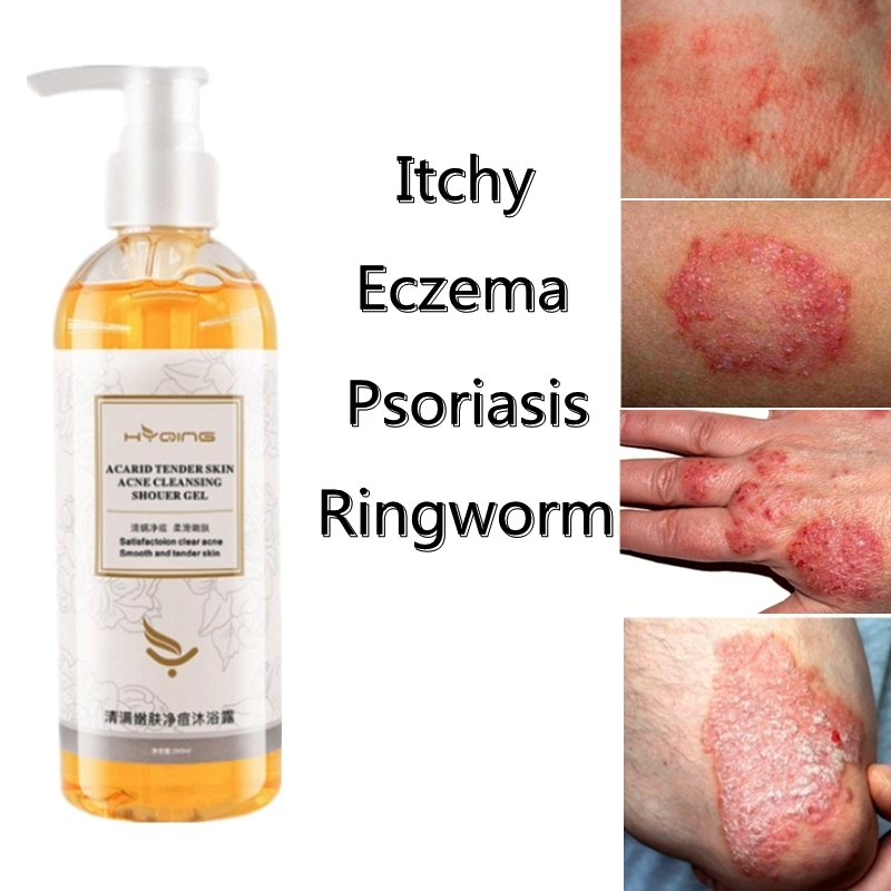 Jual eczema body wash Pengobatan Eksim psoriasis eksim kering Kurap