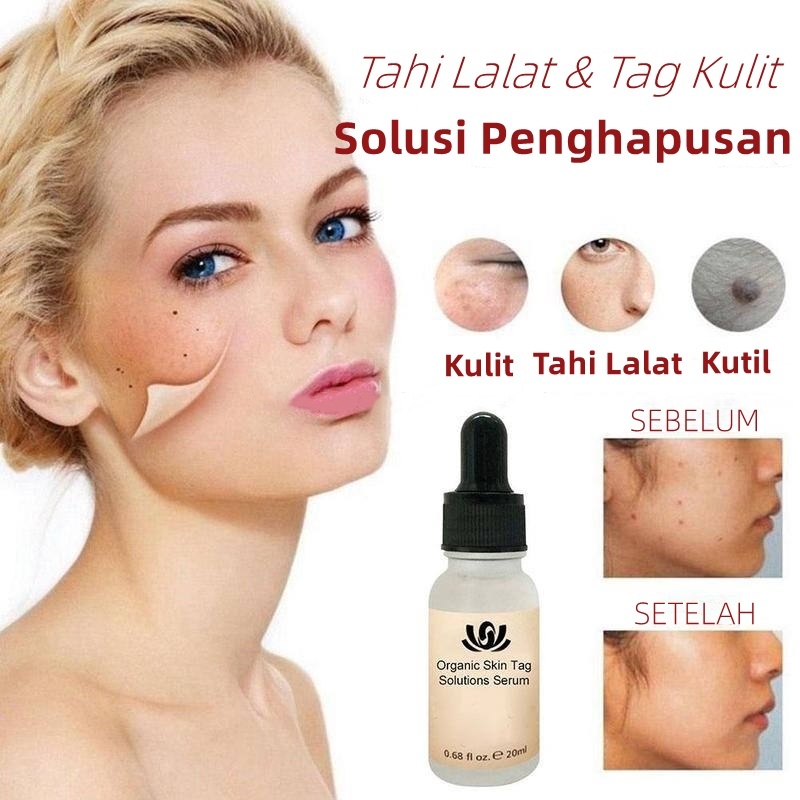 Jual [aw]wart Removal Serum Penghilang Penghilang Tahi Lalat Perbaikan