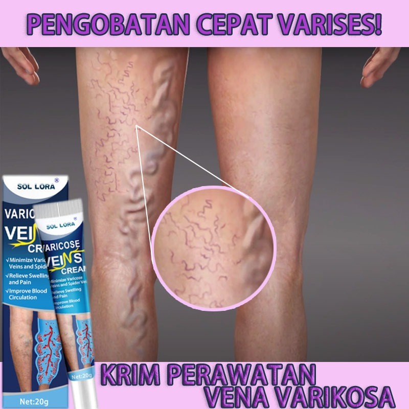 Jual Varicose Veins Cream Salep Obat Varises Ampuh Salep Urat Menonjol