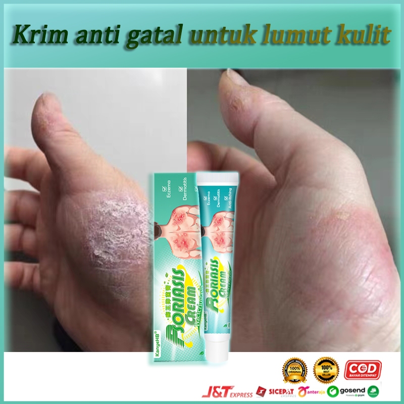 Jual salep gatal psoriasis cream salep eksim salep gatal paling ampuh