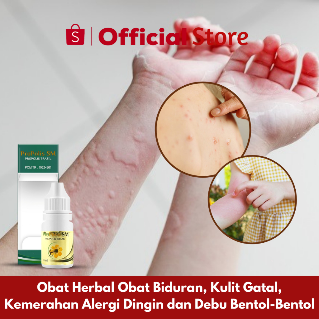 Jual Obat Biduran, Kulit Gatal, Kemerahan, Bentol-Bentol, Kaligata ...