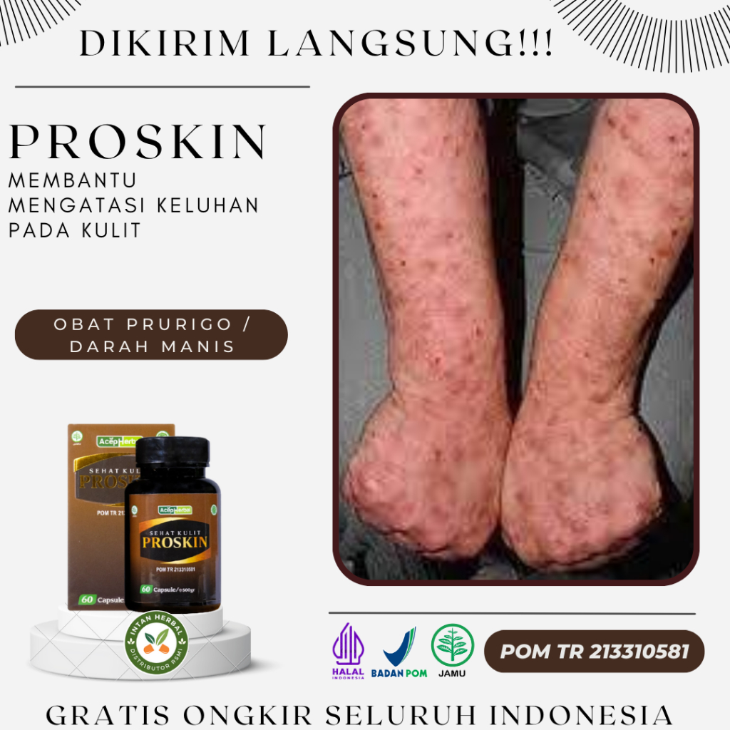 Jual Proskin 100 Original Obat Darah Manis Gatal Prurigo Bekas