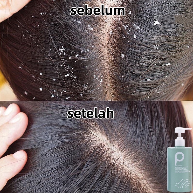 Jual Shampo buat ketombe Shampoo penghilang ketombe anti gatal ...