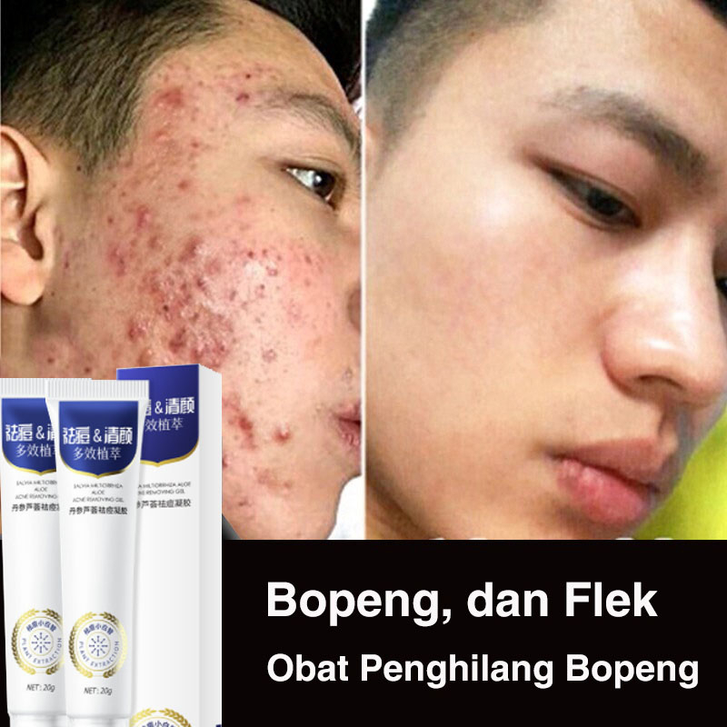 Jual 20g Obat jerawat Gel jerawat Penghilang bekas jerawat Ekstrak