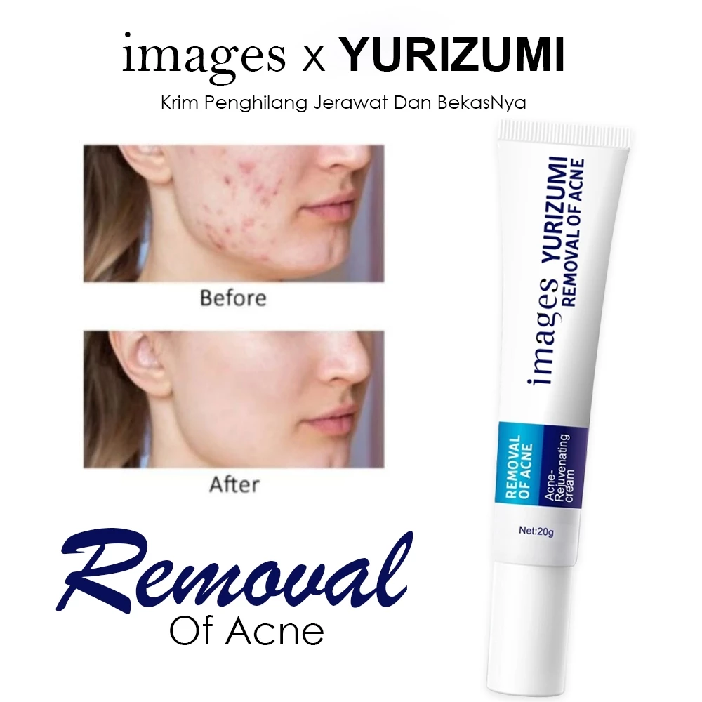 Removal Krim Penghilang Jerawat Dan Mencerahkan Wajah Paling Ampuh 20gr | AutoStock
