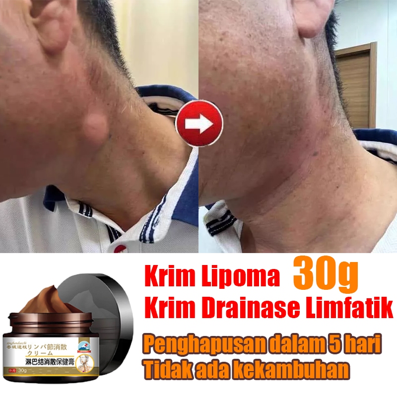 Jual Obat Benjolan Lipoma 30g Salep Lipoma Salep Benjolan Obat Benjolan ...