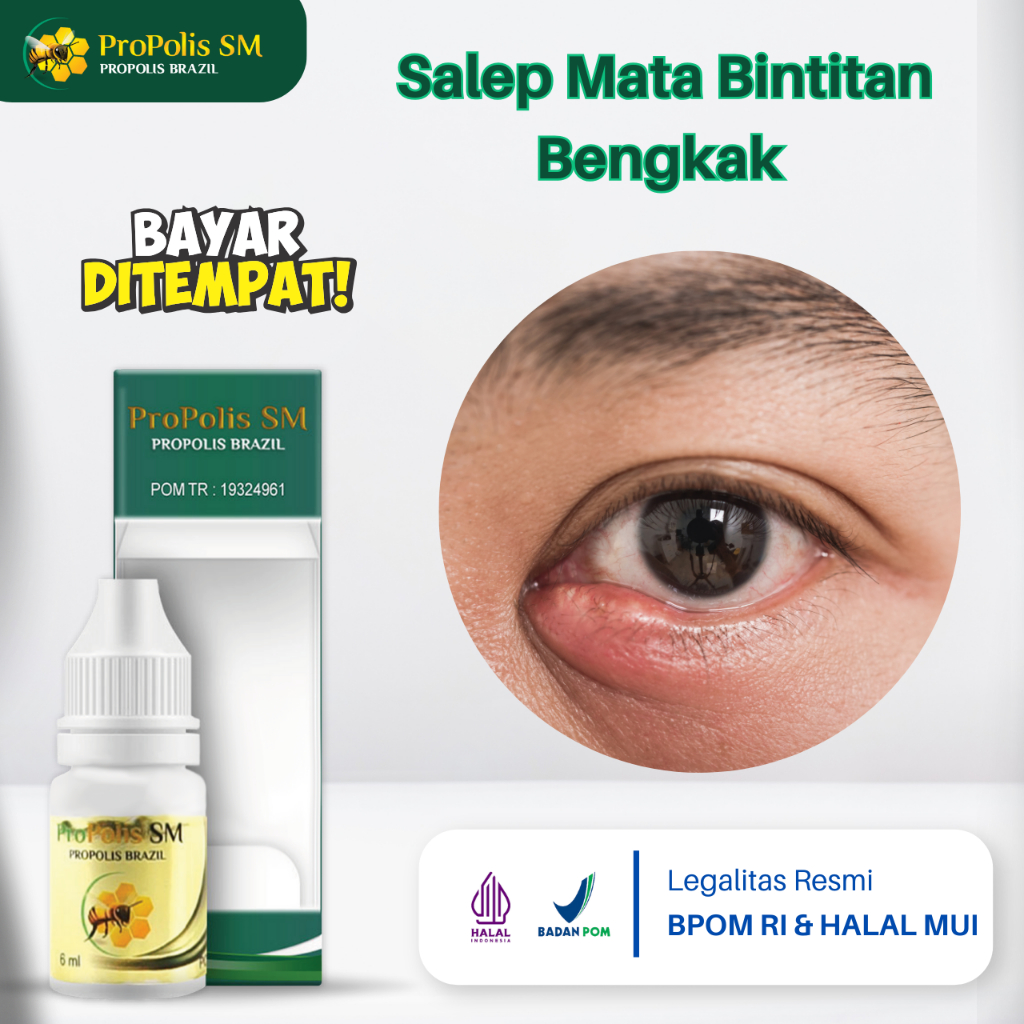 Jual Obat Mata Bintitan, Mata Kalazion, Benjolan Di Kelopak Mata, Mata ...