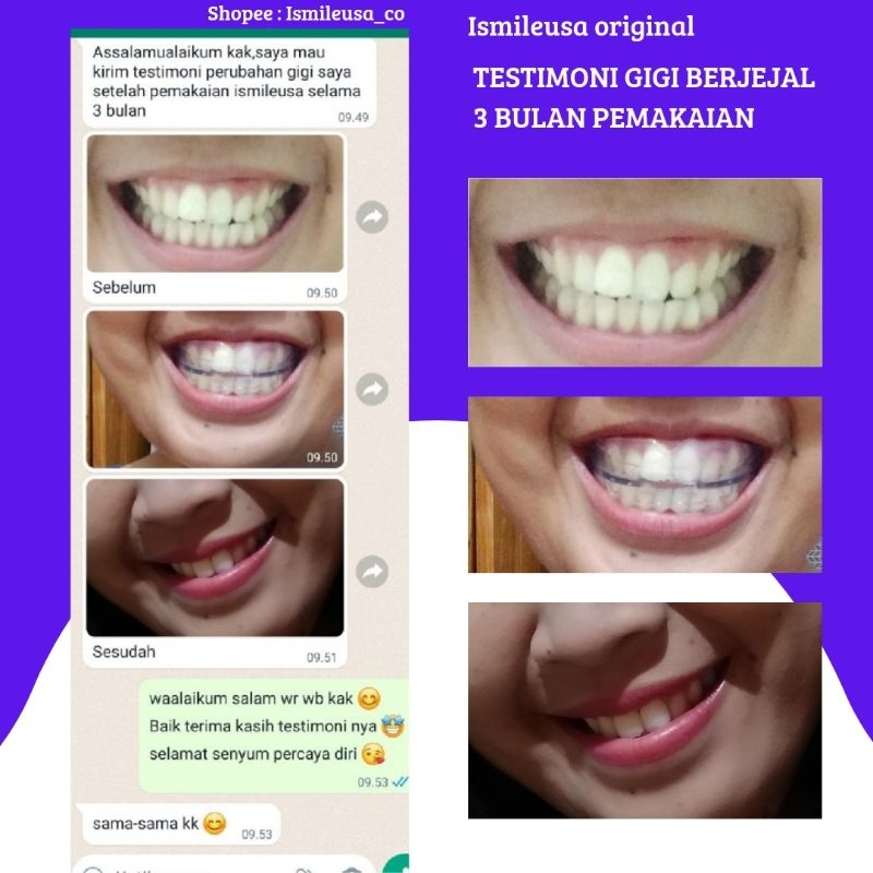 Jual IsmileUSA / Perapih Gigi /Teeth Trainer /Alignment /Aligner ...
