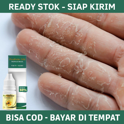 Jual Obat Jari Tangan Kering Obat Oles Kulit Jari Tangan Kering Pecah