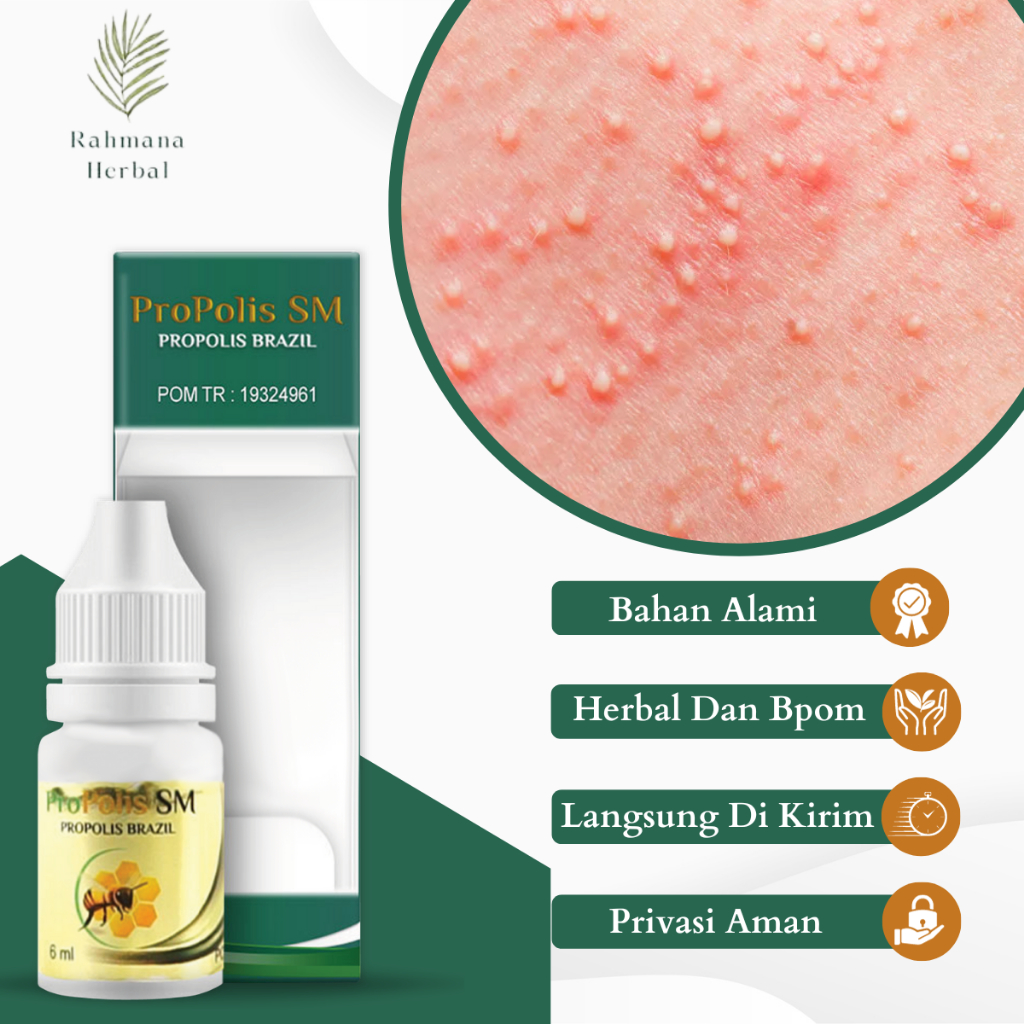 Jual Salep Obat Bintik Merah Kulit Bayi Terlengkap & Harga Terbaru ...