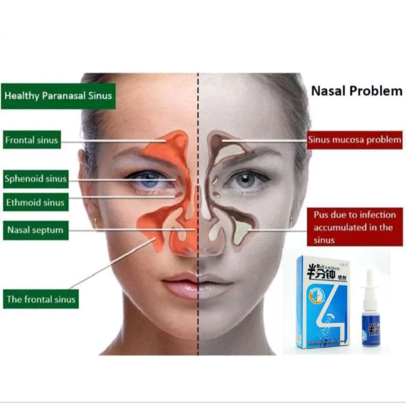 Jual Nasal Spray Rhinitis Nose Spray Sinusitis Nasal alat terapi Sinus