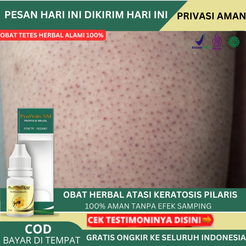 Jual Obat Keratosis Pilaris Obat Penyakit Kulit Ayam Penyakit Kulit Bintik Hitam Di Kulit 6018