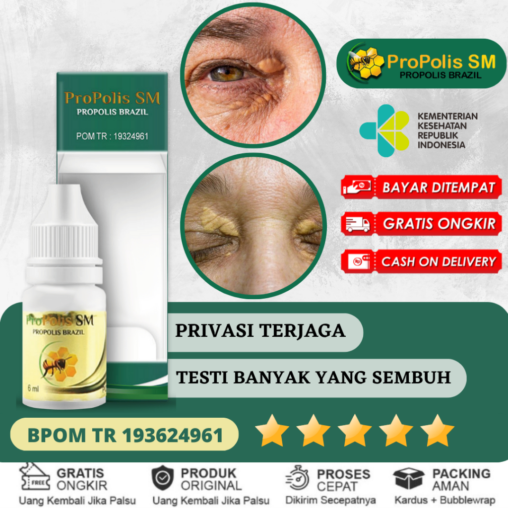 Jual Obat Penghilang Xanthelasma Gumpalan Lemak Di Kelopak Mata ...