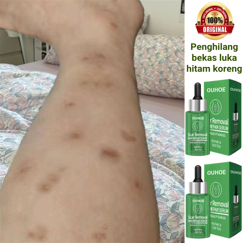 Jual Penghilang bekas luka hitam koreng Menghilangkan bekas luka Keloid