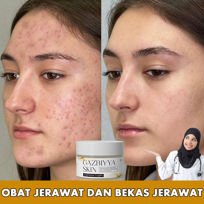 Jual Penghilang bekas jerawat obat jerawat dan bekas jerawat penghilang