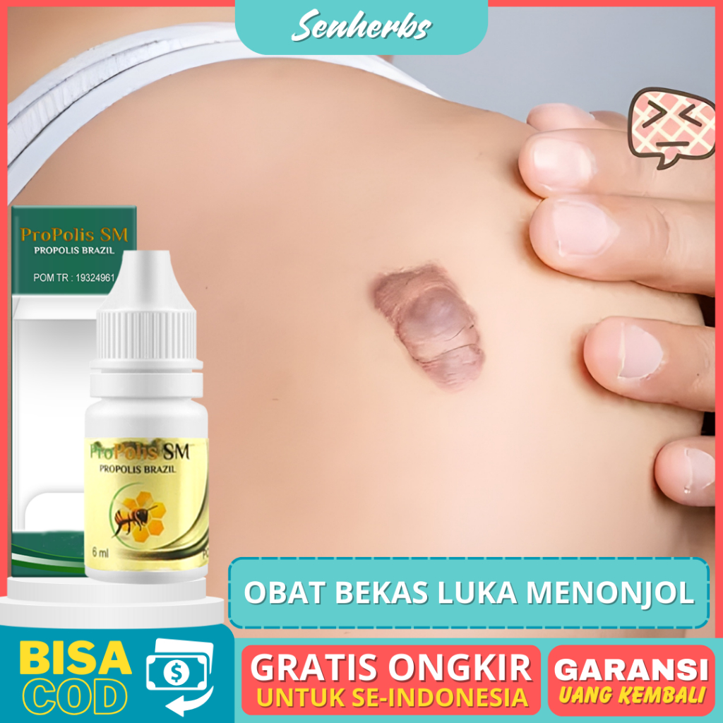 Jual Obat Bekas Luka Menonjol Penghilang Keloid Berkerut Pengering Luka