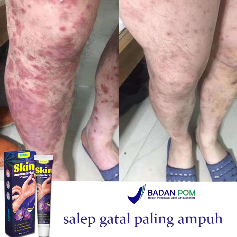 Jual salep gatal psoriasis cream salep eksim salep gatal paling ampuh